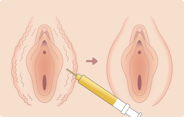 大陰唇脂肪注入