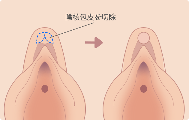 陰核(クリトリス)包茎